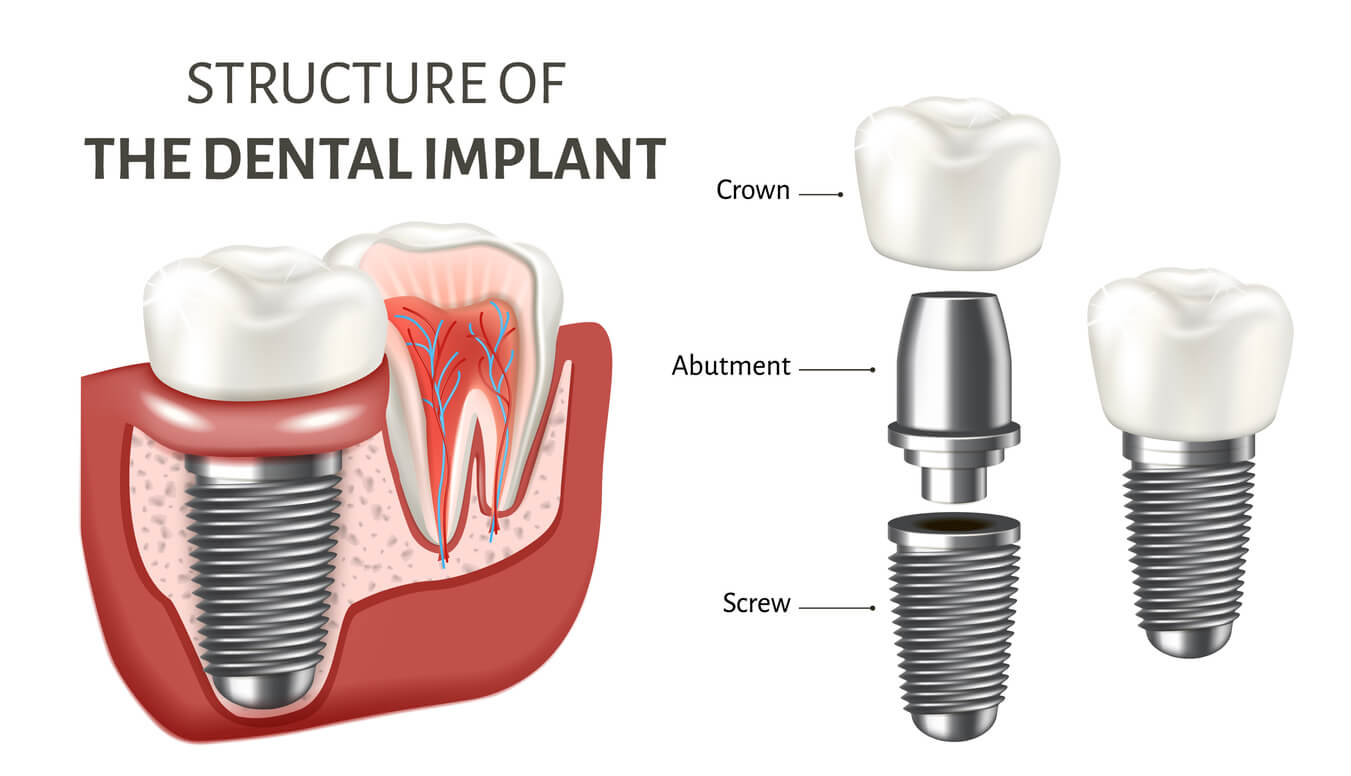 Is A Dental Implant And Crown Right For You Learn Here