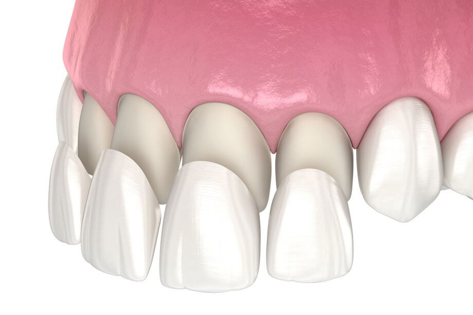 How Do Porcelain Veneers Work?